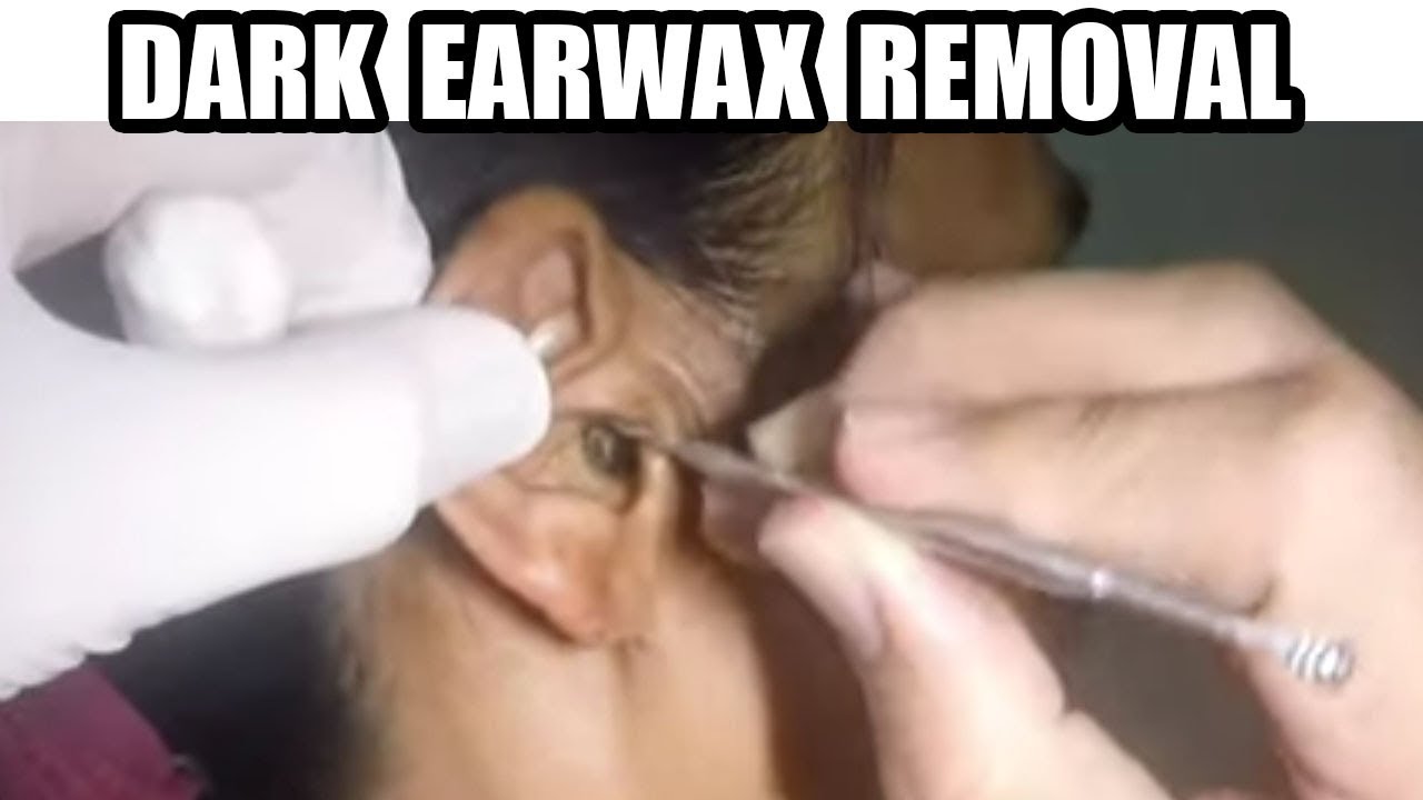 impacted ear wax removal at home